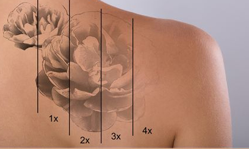 Laser Tattoo Removal